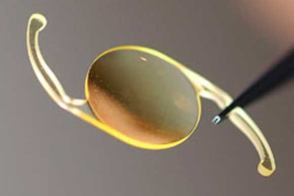 Imagem Implante de Lente Intra-Ocular